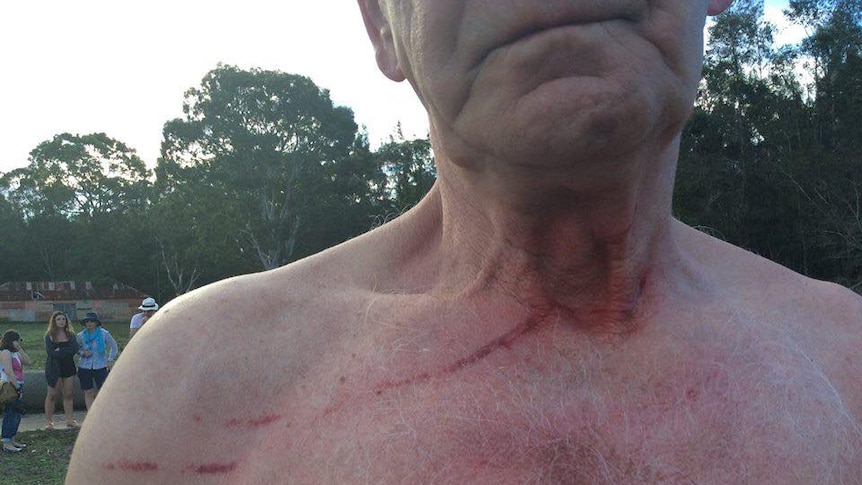 A man stands with large scratches on his neck.