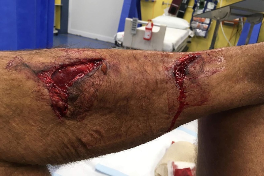 A graphic photo of Mr Barritt's injuries to his left leg.