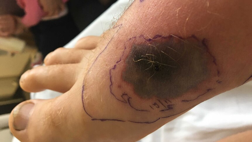 A dark bruise on the leg of snake bite victim Luke Bartlett, with lines drawn around it to help monitor its effects.
