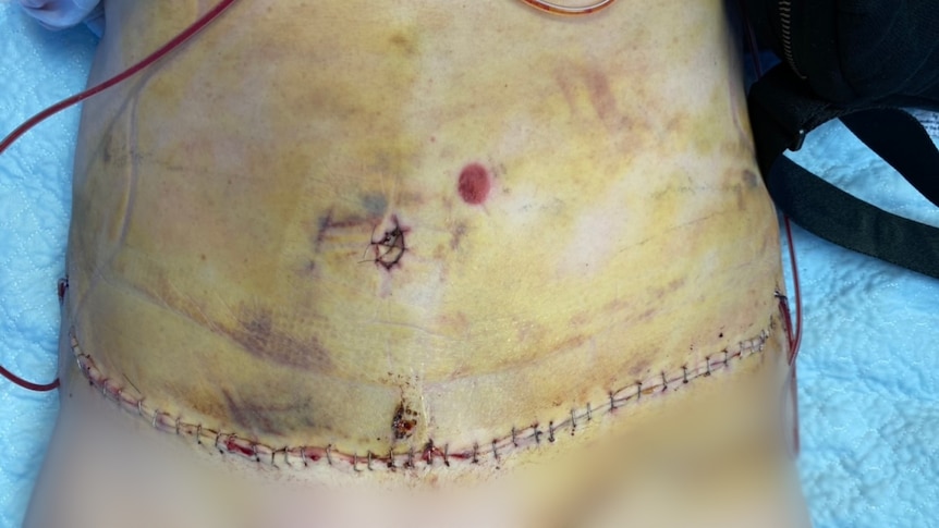 A woman's stomach after using staples to close the wound.