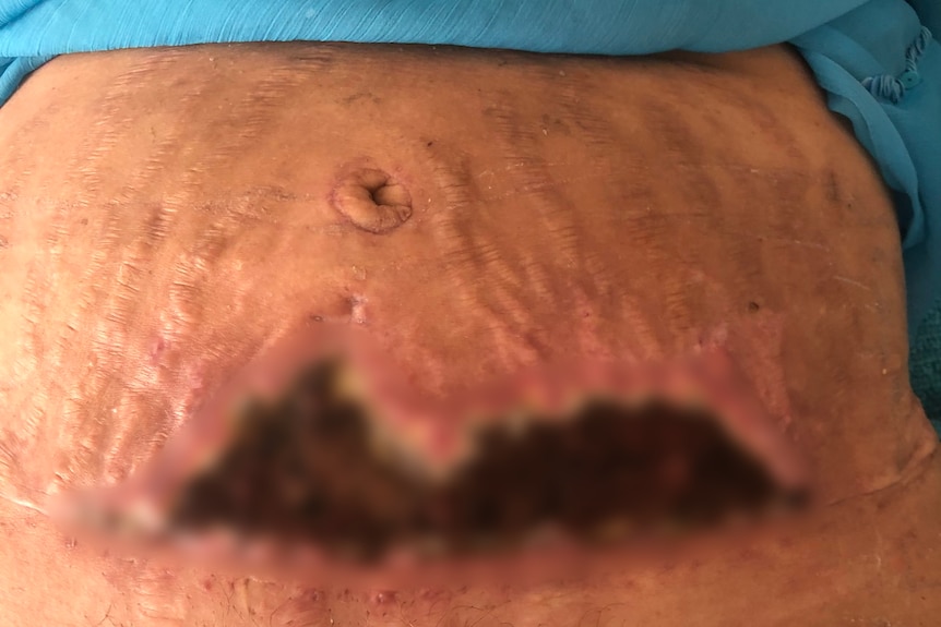 A digitally blurred image of woman's stomach with a large wound. The skin of the wound is dark brown with red raised edges.