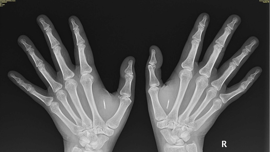 Microchip implants x-ray