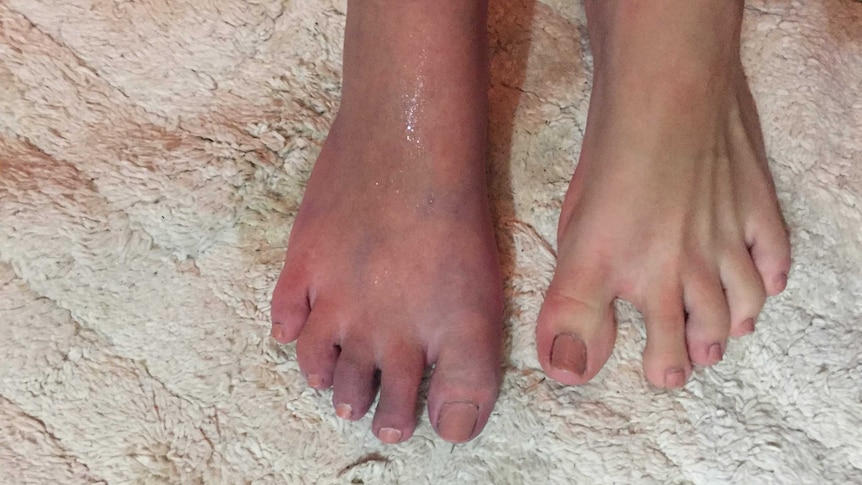 Stella Artuso's feet, one of which is swollen and red.