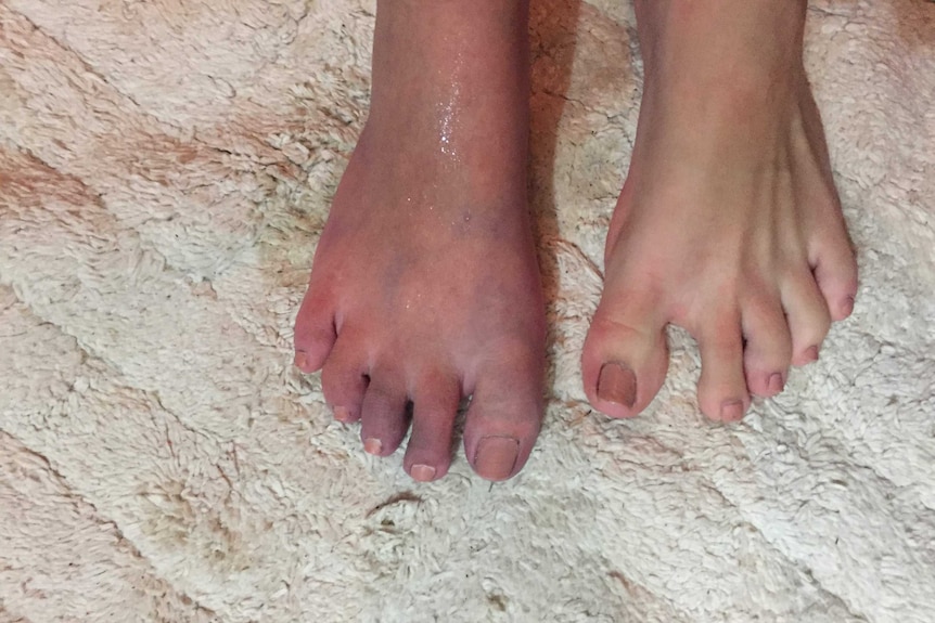 Stella Artuso's feet, one of which is swollen and red.