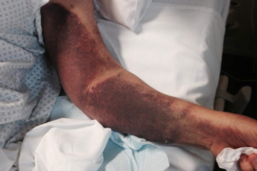 Arm injury to Elizabeth Mourik after snake bite