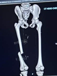 черно-бяла рентгенова снимка на крака със счупена бедрена кост