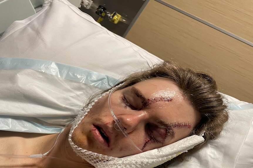 A man with facial injuries and a bandage lays on a hospital bed with his eyes closed