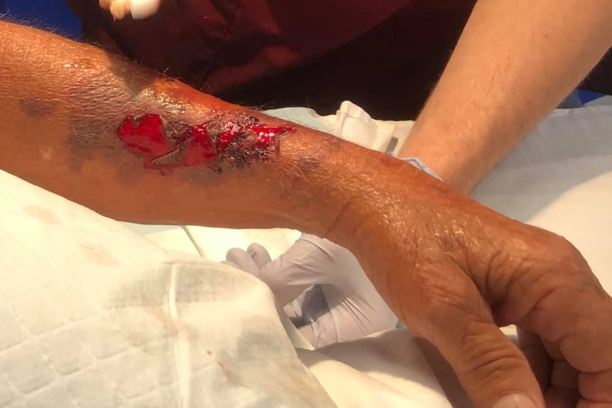 Arm wounds on an old man after a dog attack