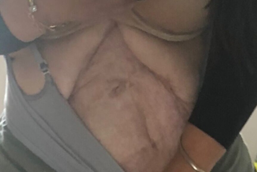 A close up photo of a woman's misfigured abdomen