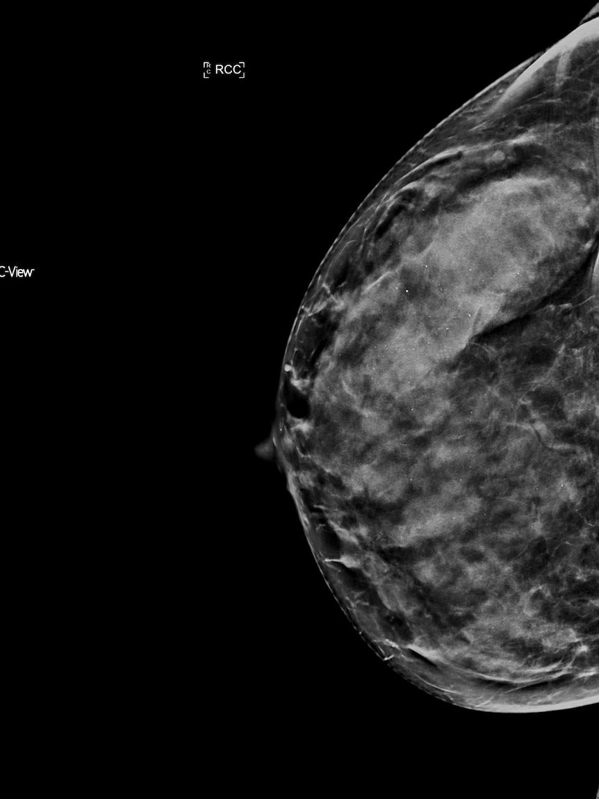 A mammogram of a dense breast.
