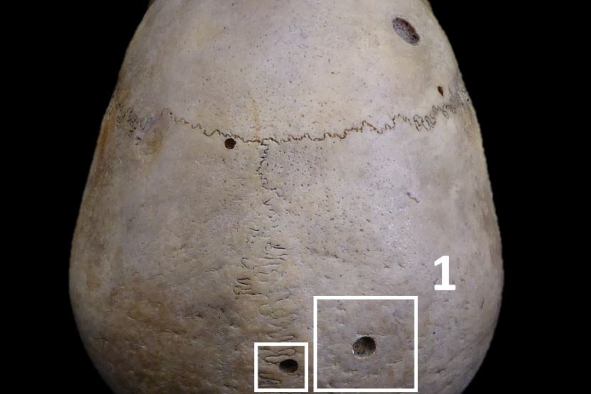 The top of a skull, with a small, damaged circle in the bone 