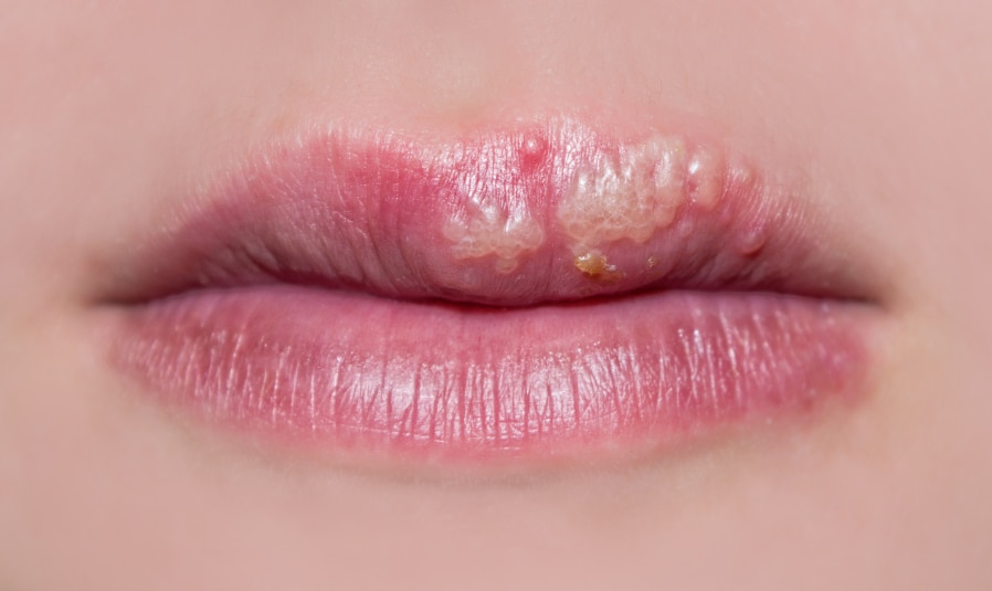 Angular Cheilitis Vs Cold Sore Ph