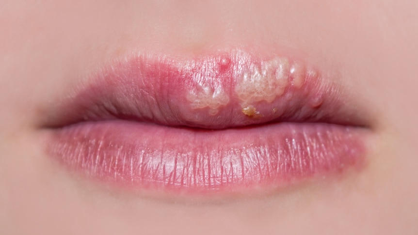On very lips bumps tiny What Causes