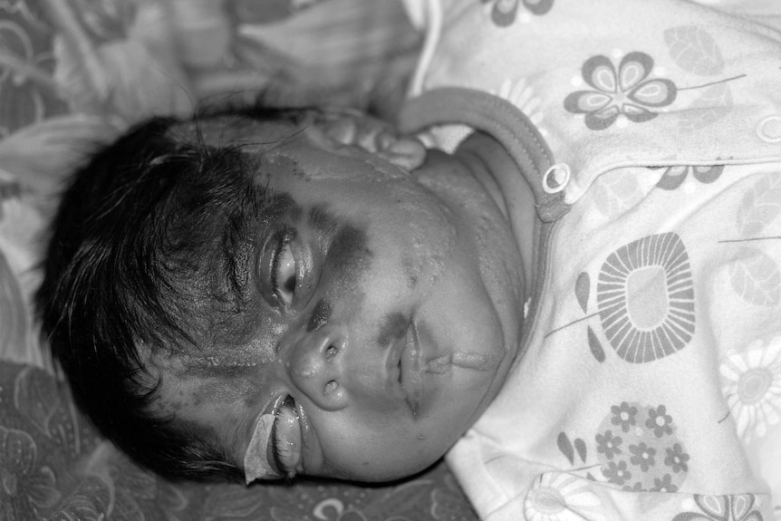 A black and white photo of a disfigured baby lying on a bed.