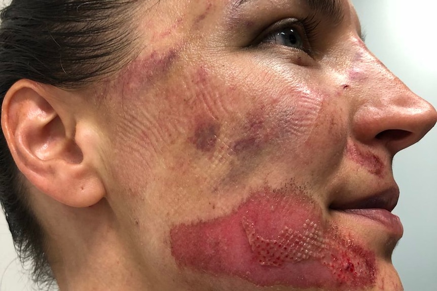 Rebecca Wiasak shows off the injuries she sustained during the Women's Tour Down Under in Adelaide