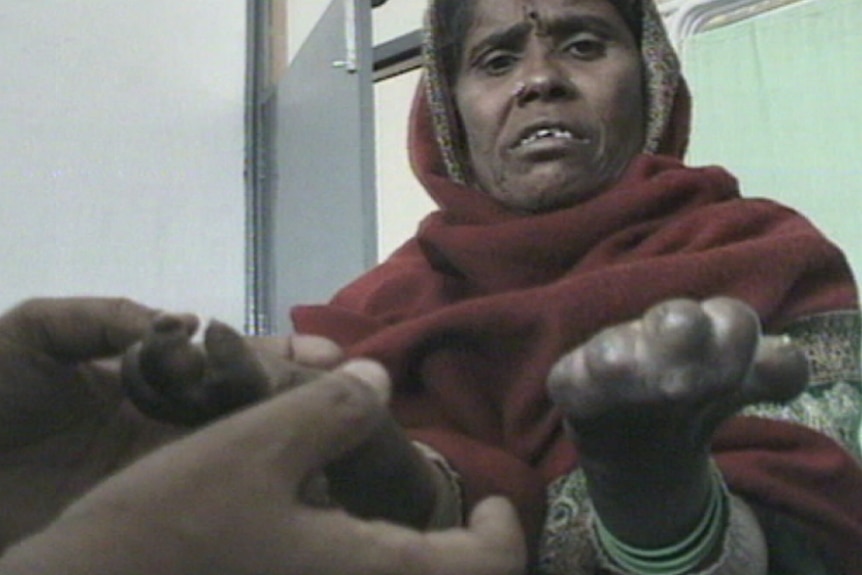 A lady holds up her hands, revealing stubs where fingers should be.