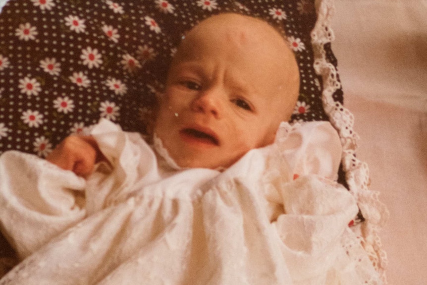 A baby in a christening gown with a visibly thin face.