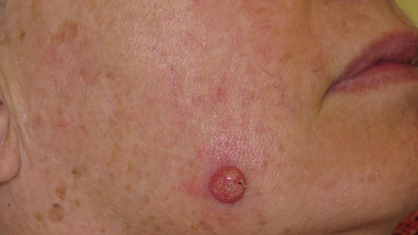 This skin cancer is a combination of squamous cell carcinoma with keratoacanthoma.