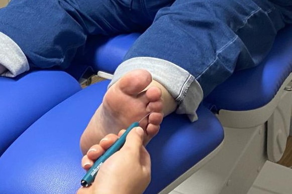 Close up of a hand holding a podiatry surgical knife close to a person's left foot.