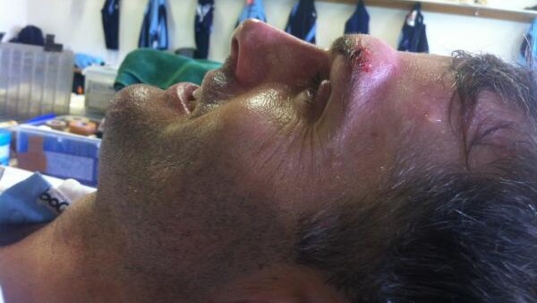 Katich shows off his battle scars in the Blues dressing rooms.
