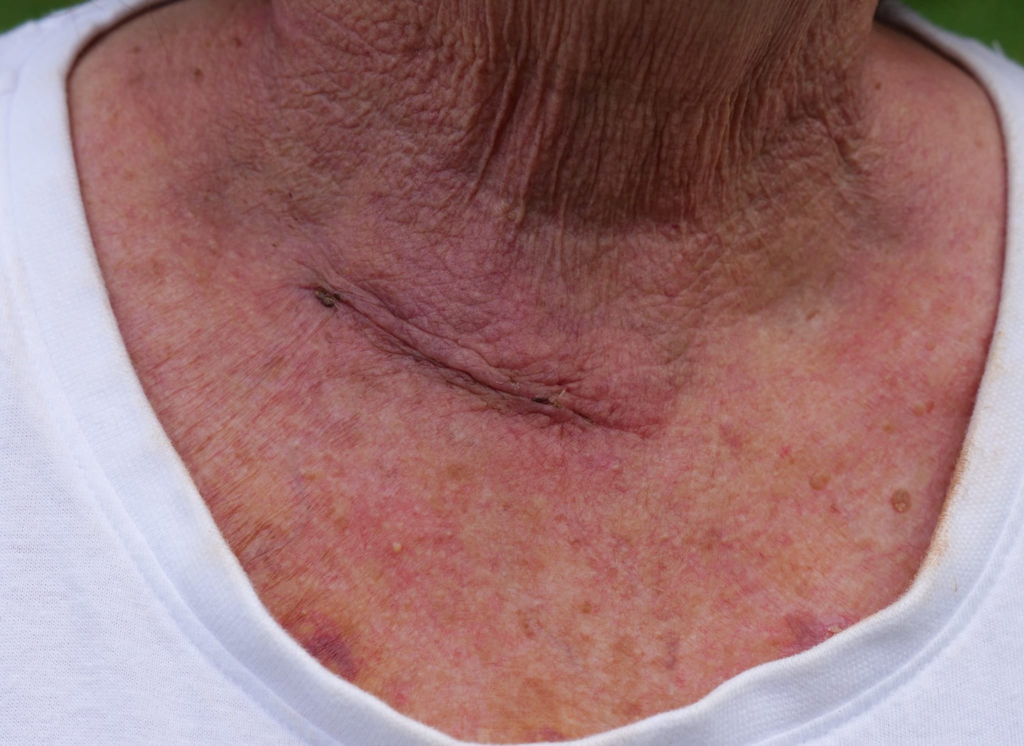 Close-up of recently healed scar, just above a lady's collarbone.