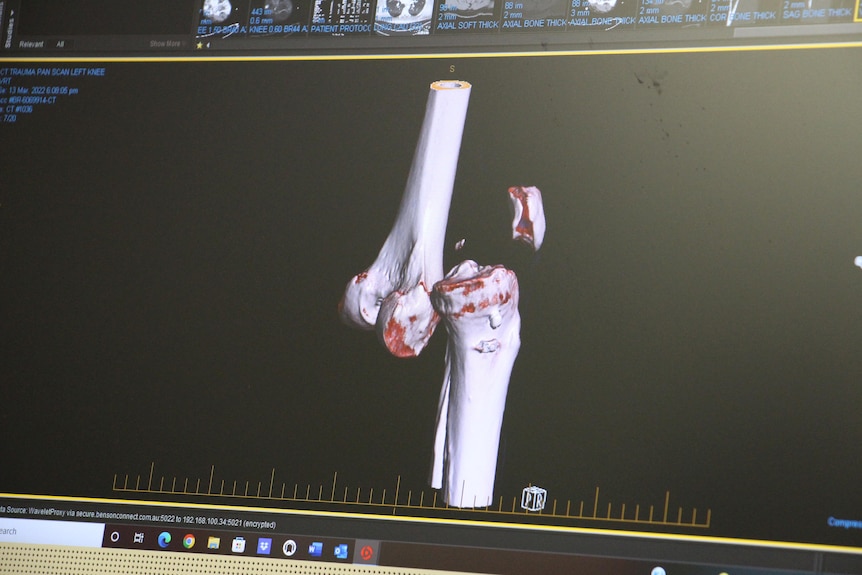 Une image 3D d'un genou cassé