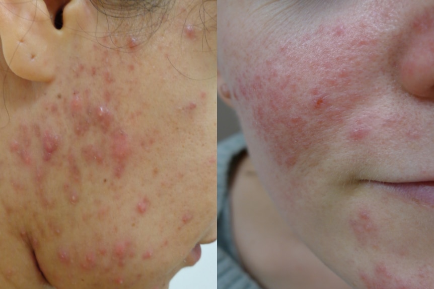 A composite image shows acne vulgaris and acne rosacea.