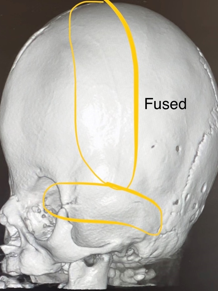 A CT scan of a baby's skull