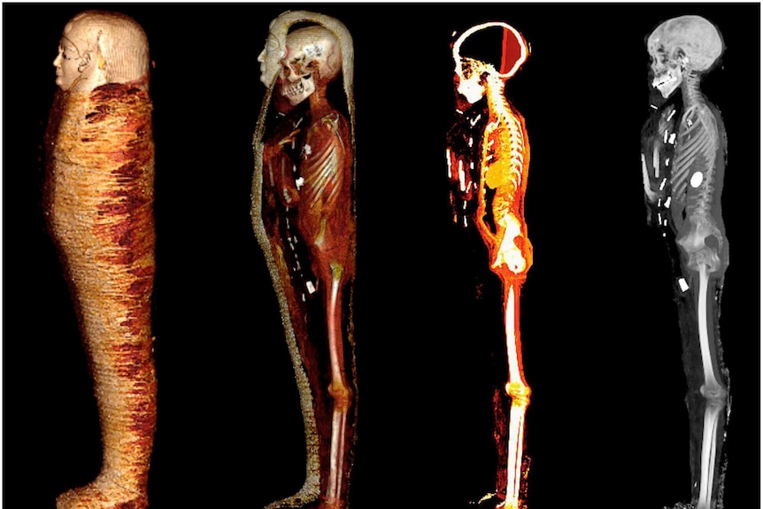 An Xray of a mummy shows the different layers through to the skeleton on the inside. 