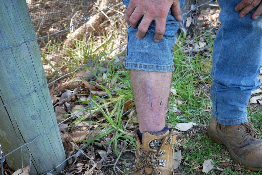 Man's calf showing long scar from mountain bike injury.