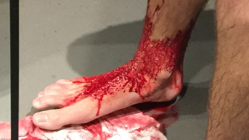 Blood on Sam Kanizay's legs after he was apparently bitten by small marine creatures.