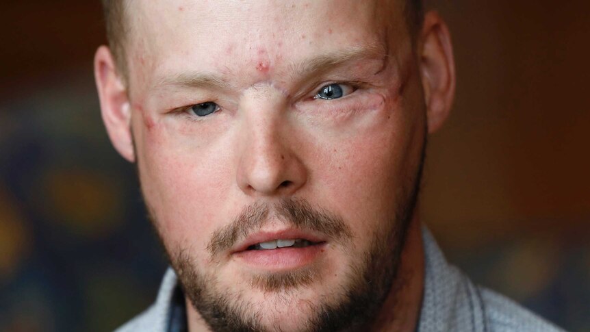Face transplant recipient Andy Sandness speaks during an interview.
