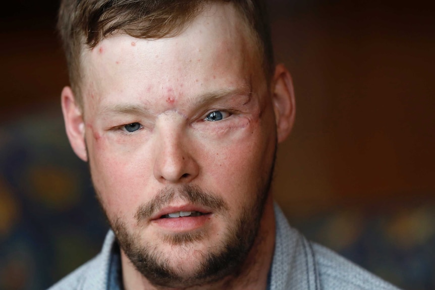 Face transplant recipient Andy Sandness speaks during an interview.