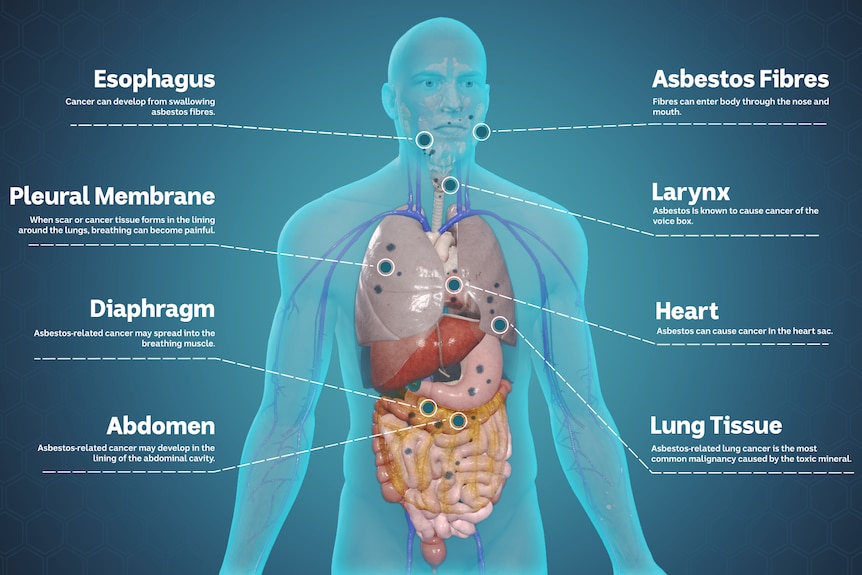 A graphic showing how asbestos impacts the different organs in the body