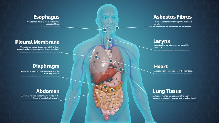 A graphic showing how asbestos impacts the different organs in the body