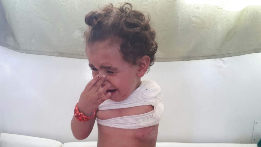 A crying toddler with her left arm missing and bandages around her torso holds her hand to her face.