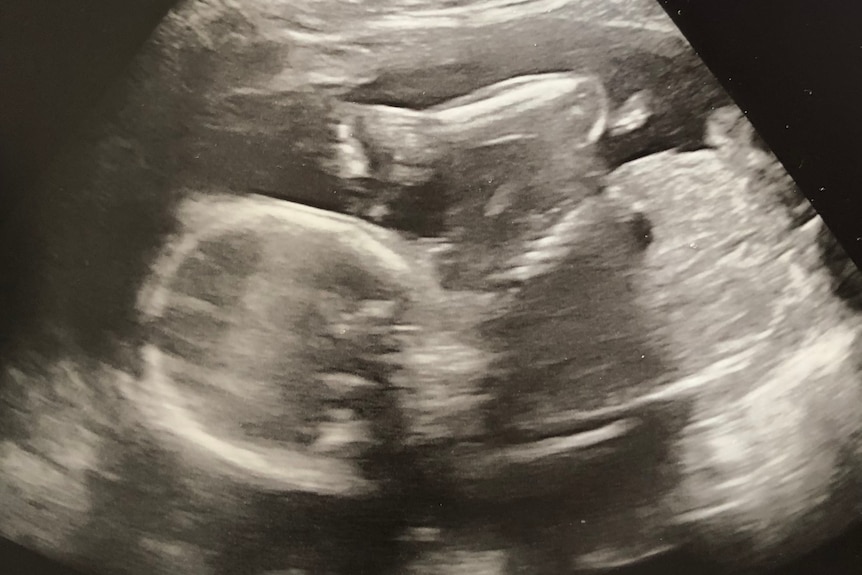 An ultrasound of a baby at around 21 weeks