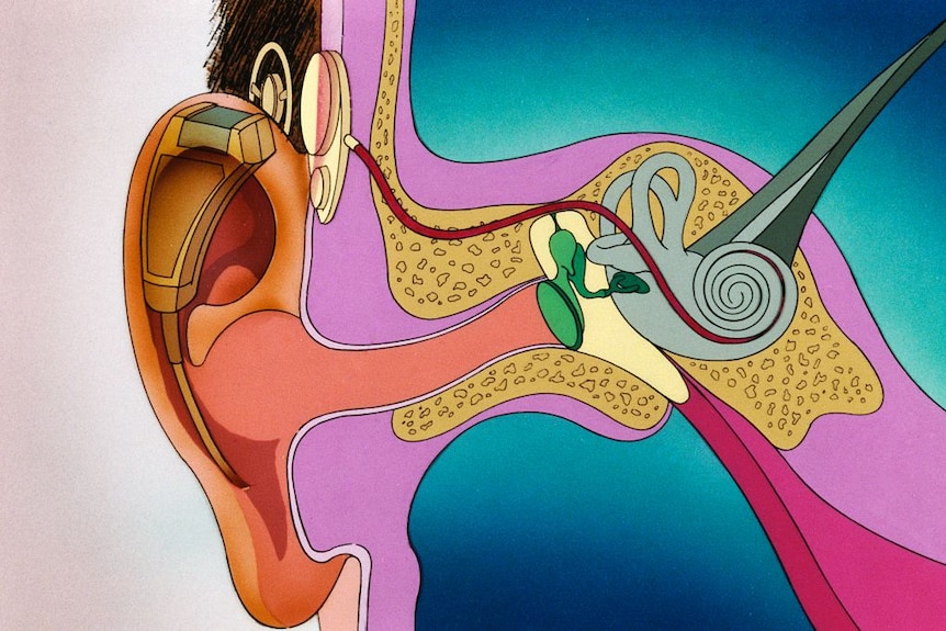 An illustration of a cross-section of the ear, showing a wire connecting to the spiral cochlea in the inner ear.
