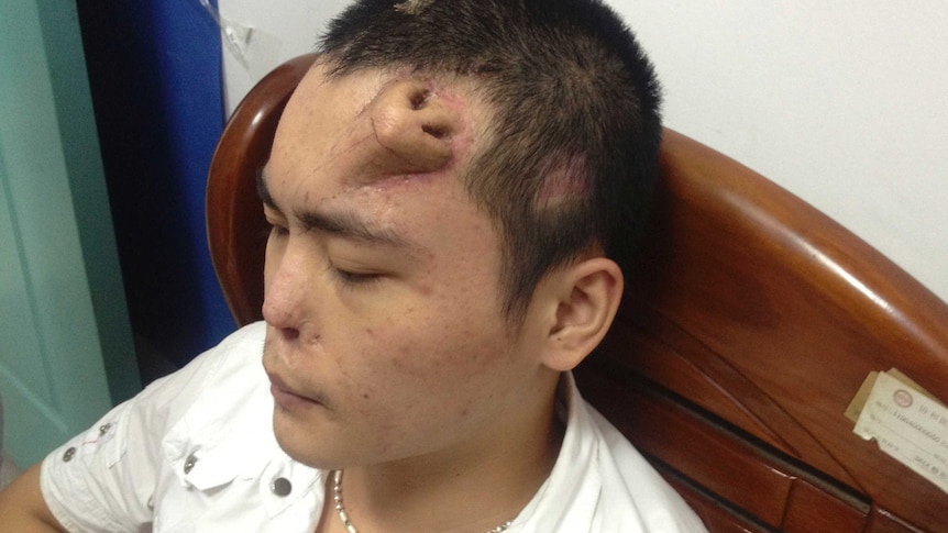 Chinese man grows new nose on his forehead