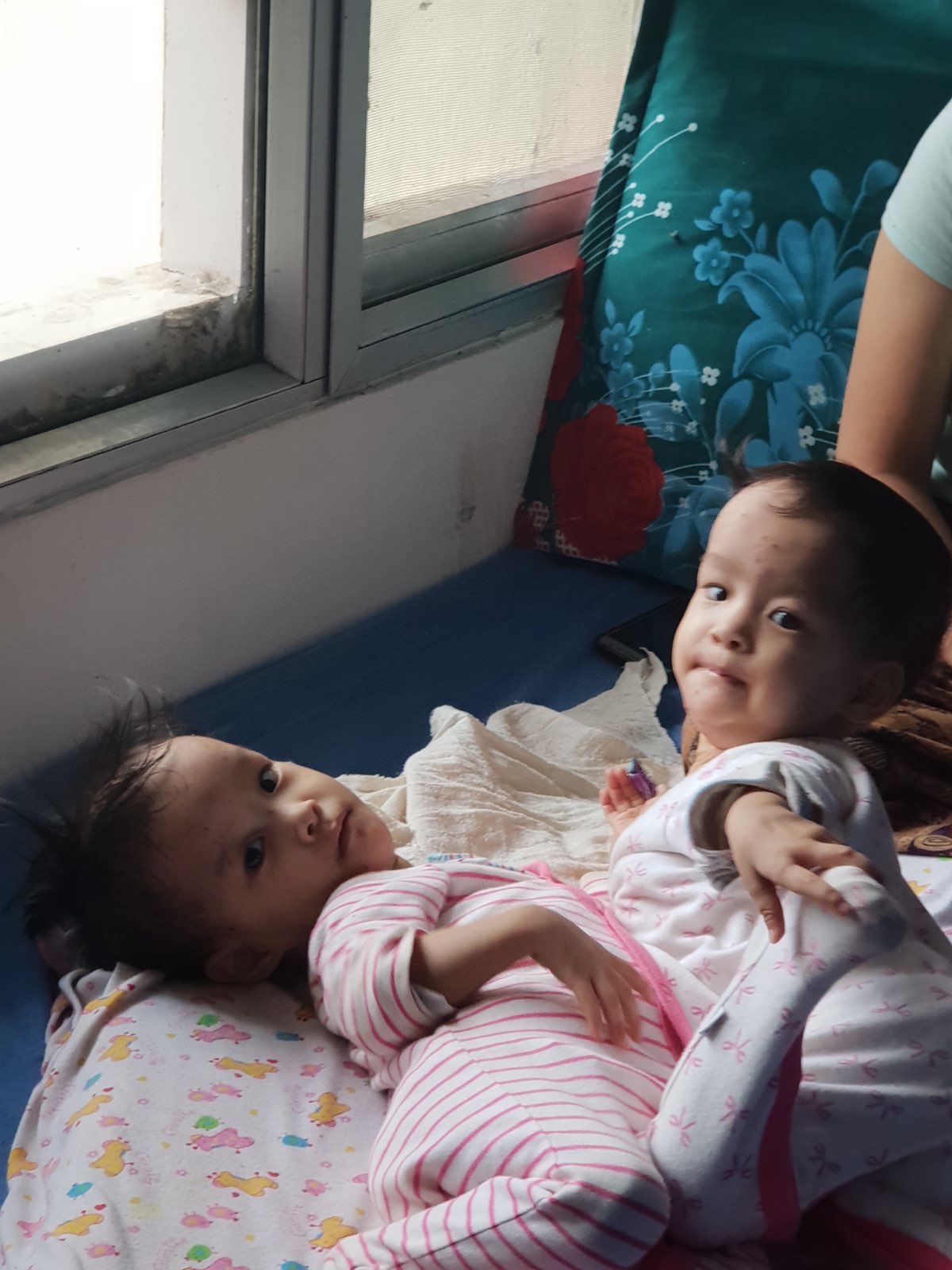 Conjoined twins Nima and Dawa declared ready for separation surgery on  Friday - ABC News