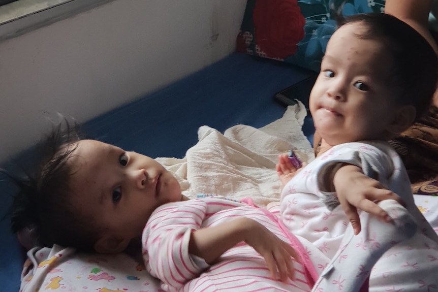 Conjoined twins Dawa and Nima lying on a mattress dressed in baby clothing.