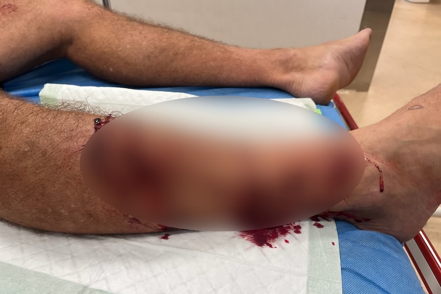 A blurred image of a mans bloodied leg