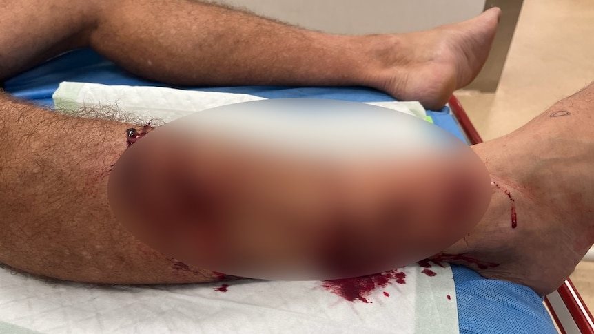 A blurred image of a mans bloodied leg
