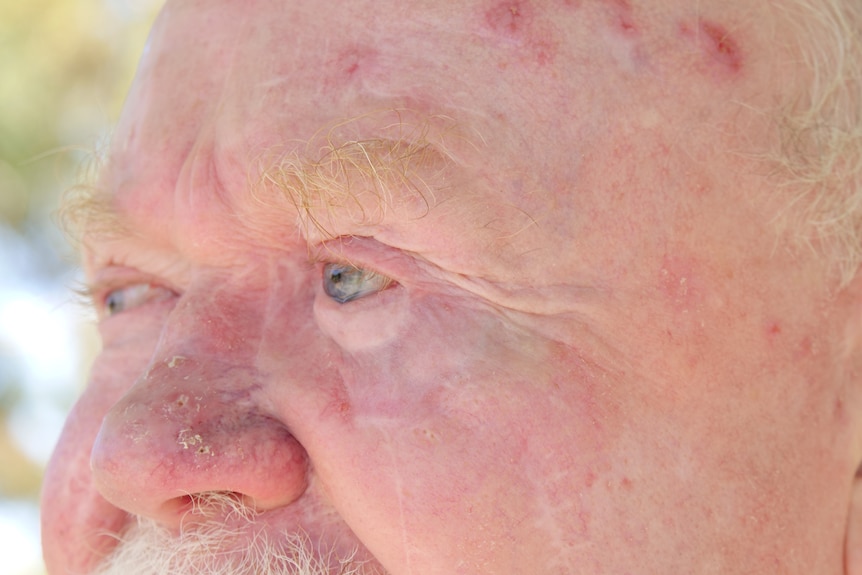A close up of a Caucasian man with blue eyes, scars on his forehead.