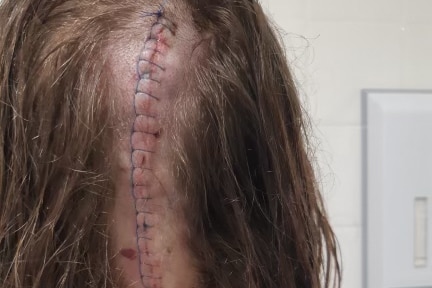 A scar on the back of someone's head