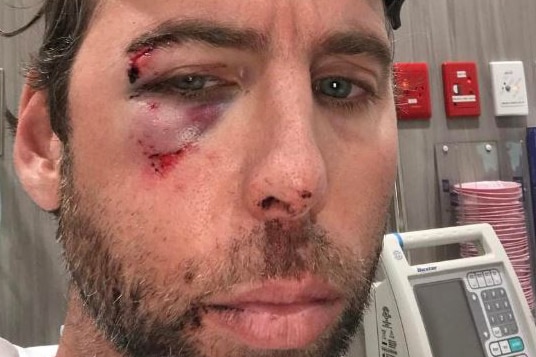 Former Olympian Grant Hackett posts photo of bruised and bloodied face on Instagram