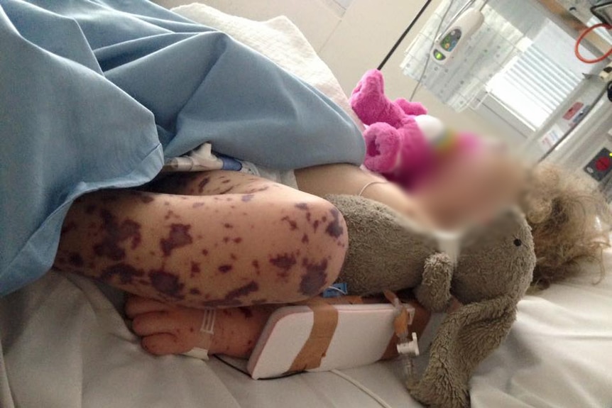 A young girl with her face pixellated lies on a hospital bed with a deep red meningococcal rash on her leg.