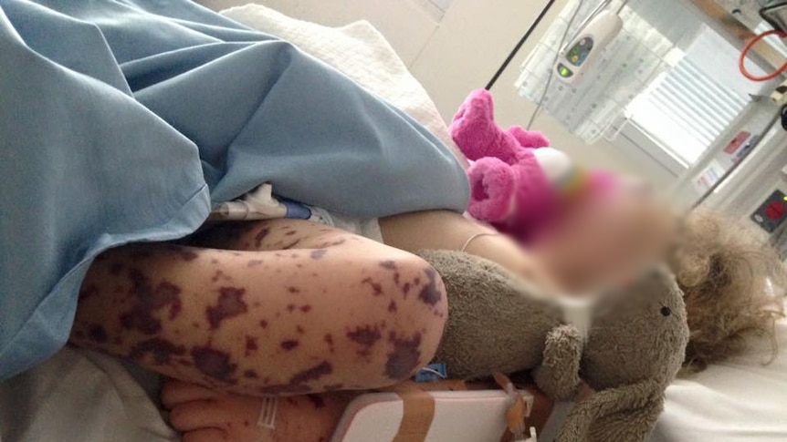A young girl with her face pixellated lies on a hospital bed with a deep red meningococcal rash on her leg.