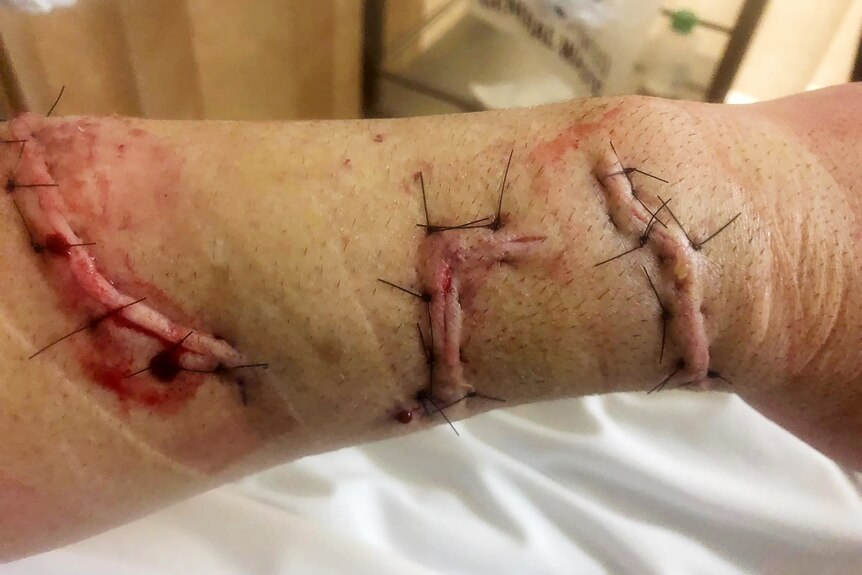 A close-up of wounds stitched up on a man's arm