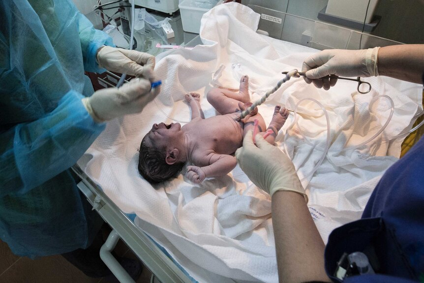 A newborn baby has its umbilical cord cut by doctors.